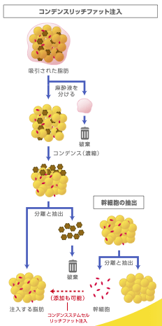 コンデンスリッチファット注入