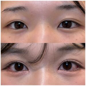 20代女性、目尻延長切開、目頭切開、術前と1か月後