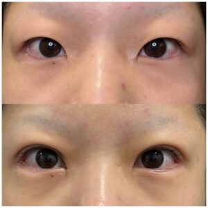 20代女性、目尻延長切開、目頭切開、二重全切開の術前と1か月後
