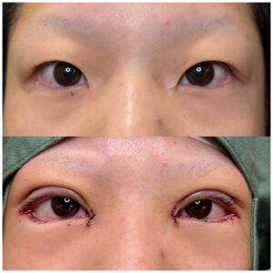 20台女性、目尻切開、目尻延長切開術前と術直後