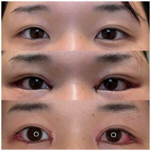 目尻延長切開、目頭切開の術前、直後、1数看護