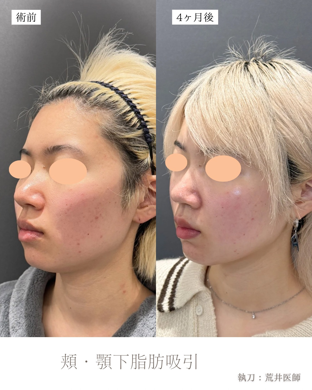 小顔脂肪吸引