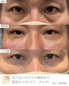目の下の切らないたるみ取り