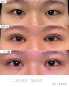 二重全切開