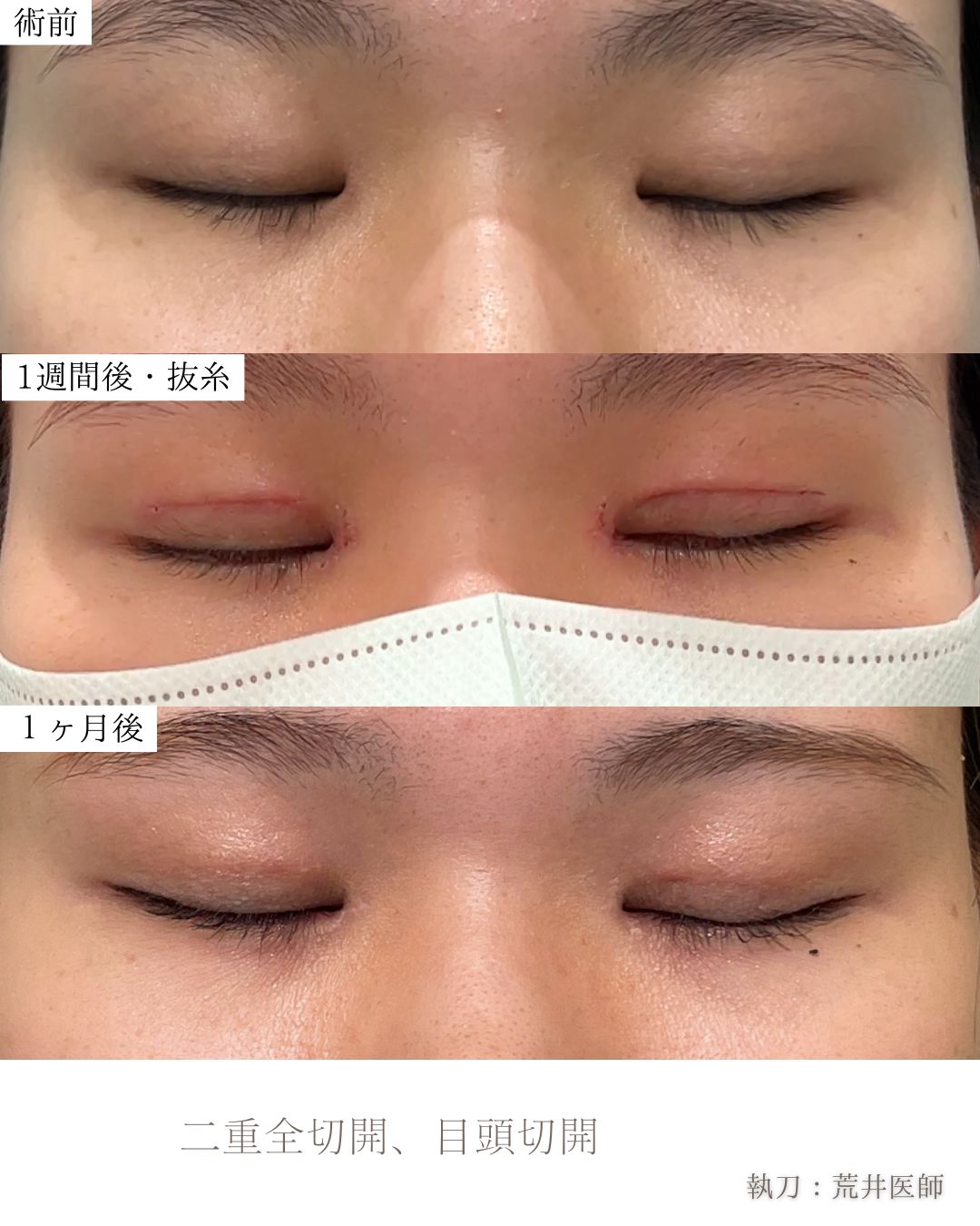 目頭切開
