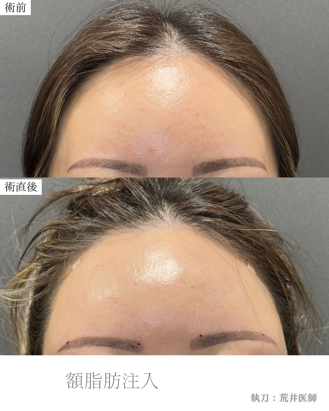 額脂肪注入ダウンタイム