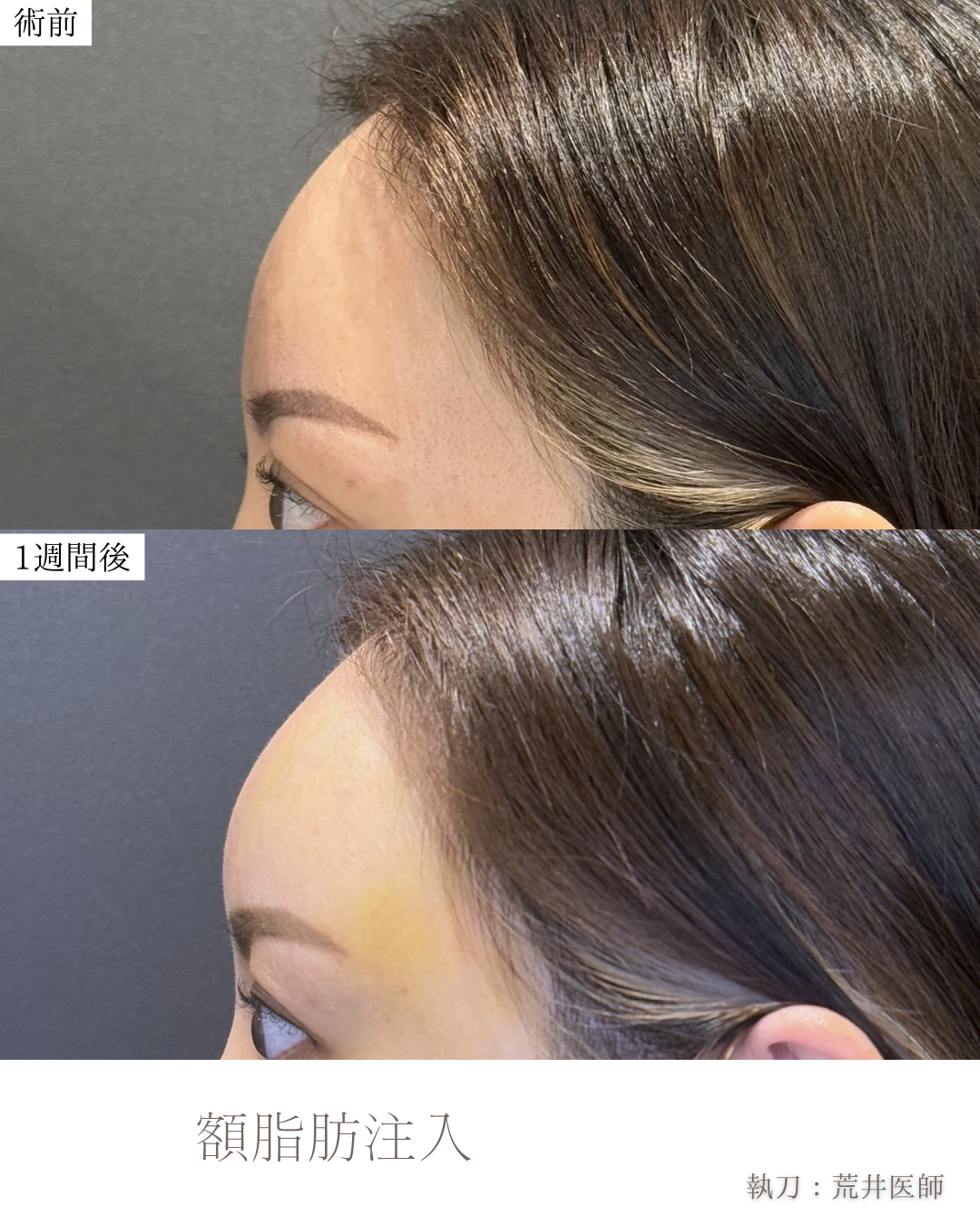 額脂肪注入ダウンタイム