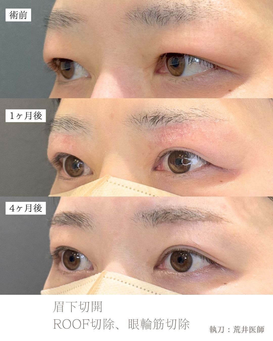 眉下切開症例