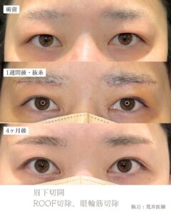 眉下切開症例