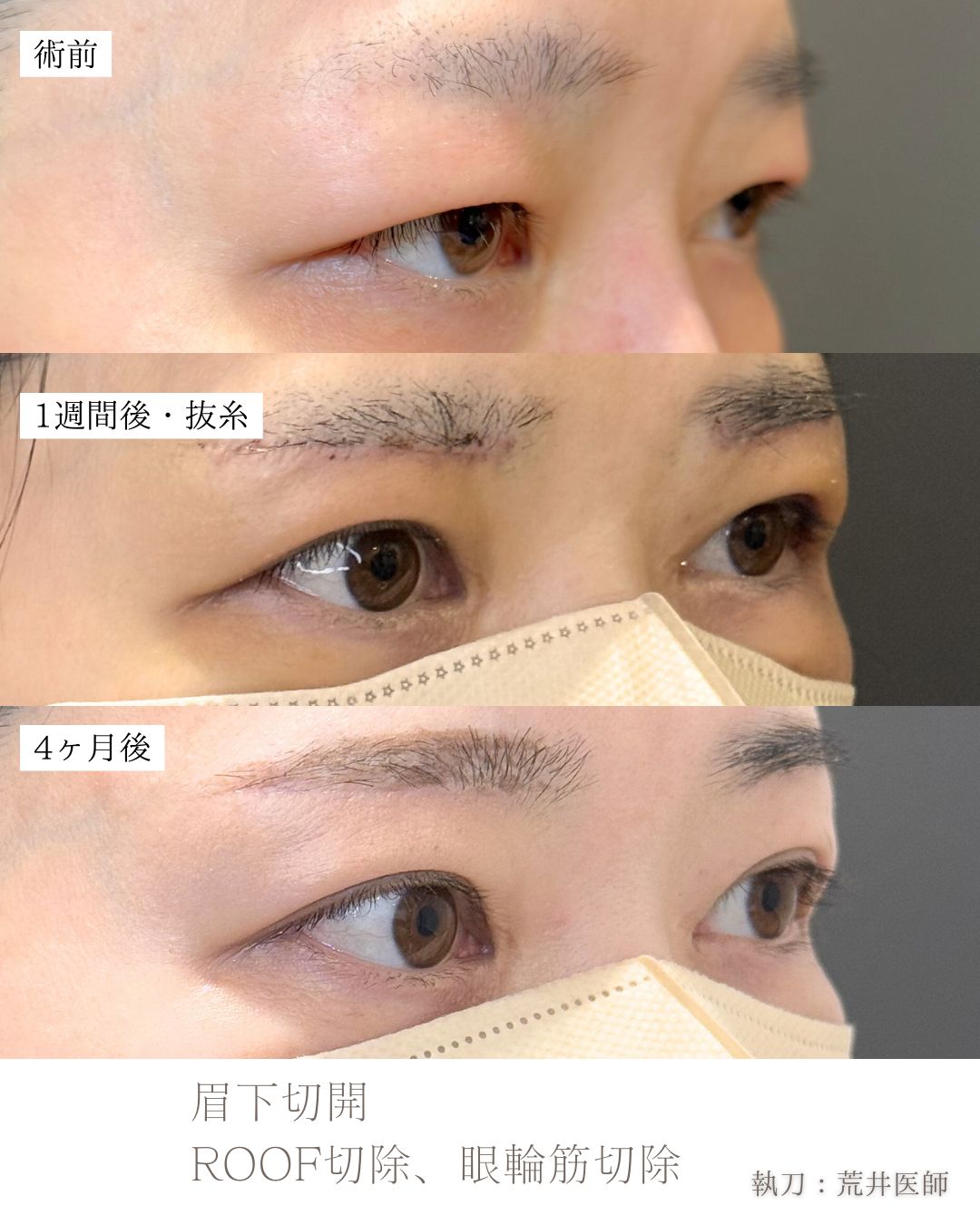 眉下切開症例