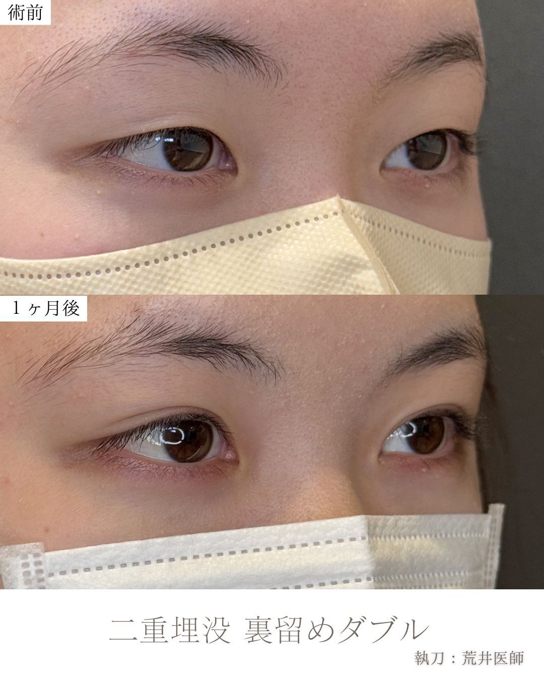 二重埋没裏留め