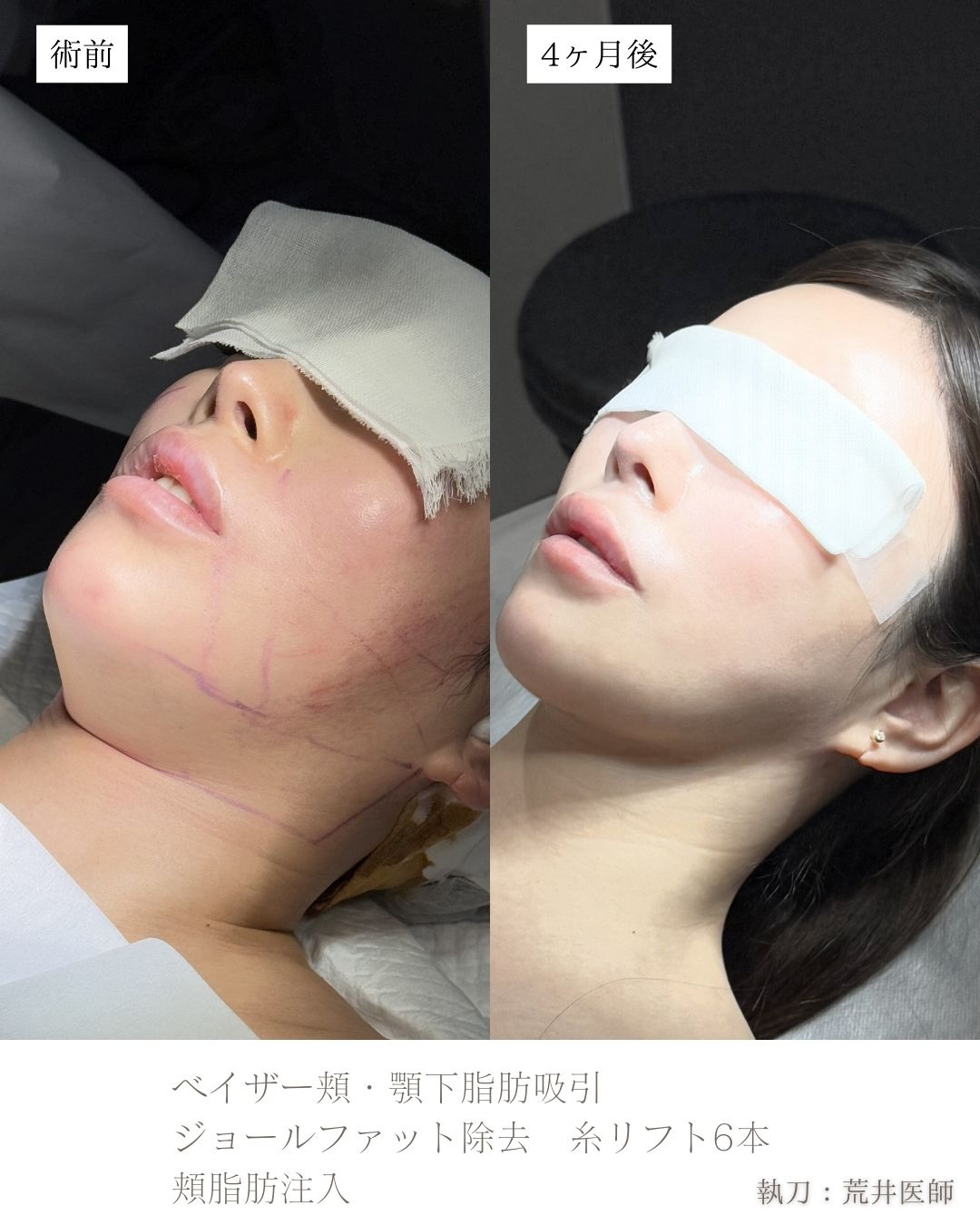 小顔脂肪吸引　ジョールファット　ベイザー