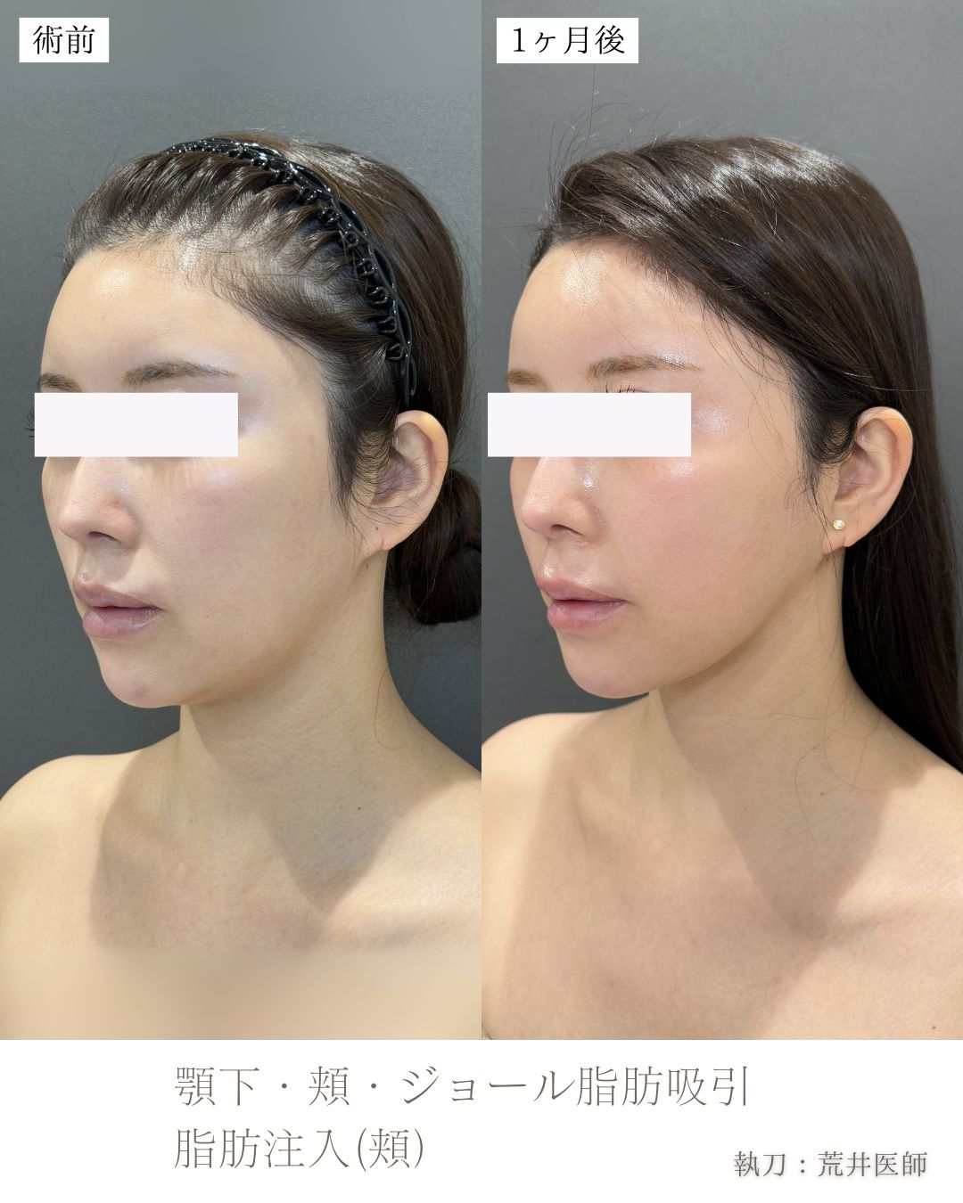 小顔脂肪吸引、ジョールファット、頬脂肪注入