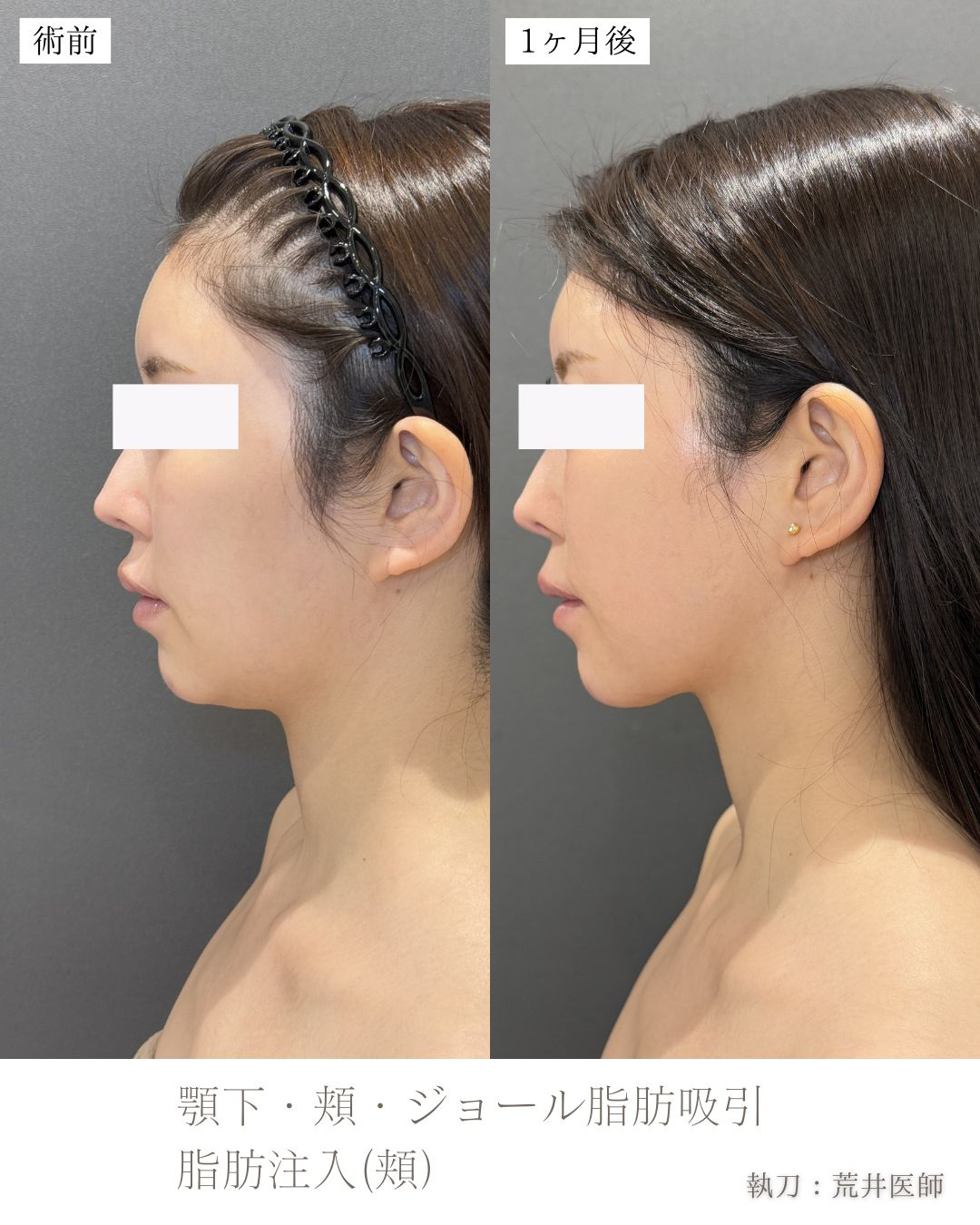 小顔脂肪吸引　ジョールファット　ベイザー