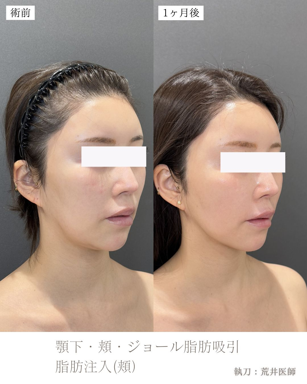 小顔脂肪吸引　ジョールファット　ベイザー