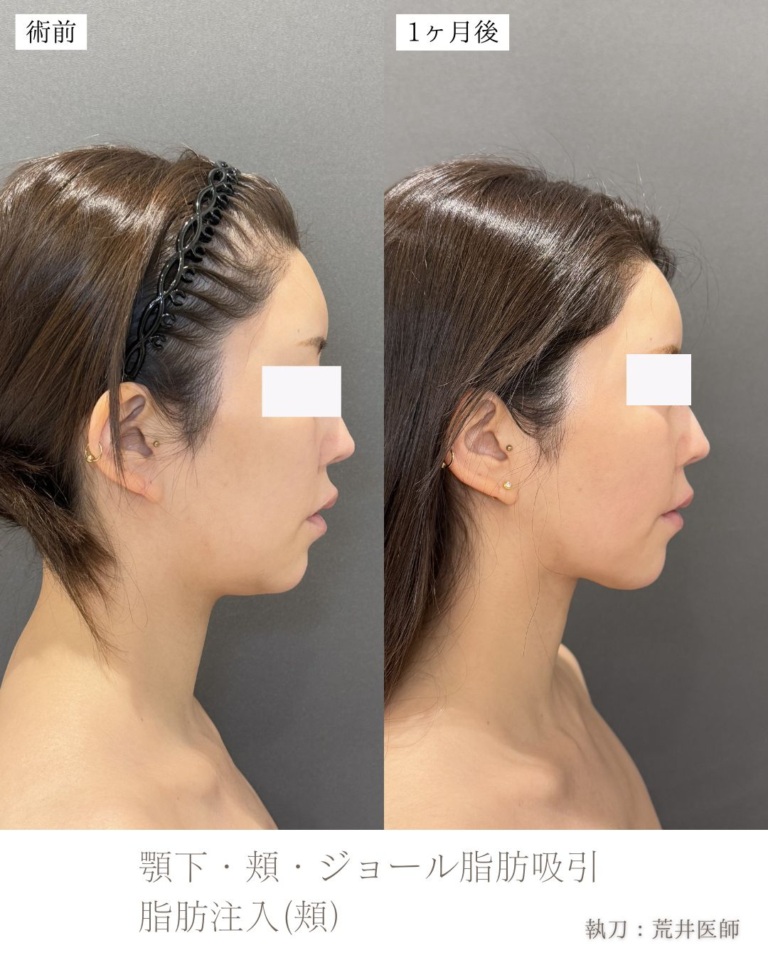小顔脂肪吸引　ジョールファット　ベイザー