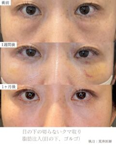 目の下脂肪注入
