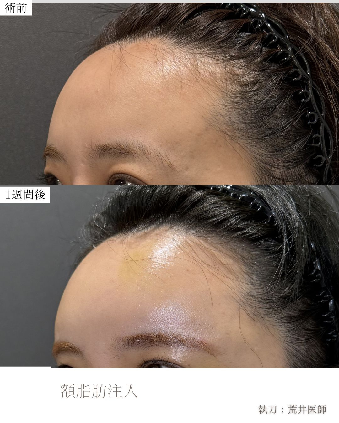 額脂肪注入