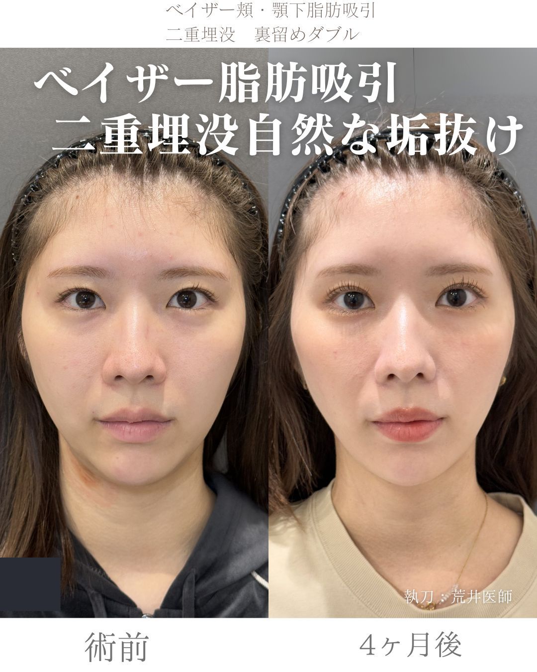 ベイザー脂肪吸引症例