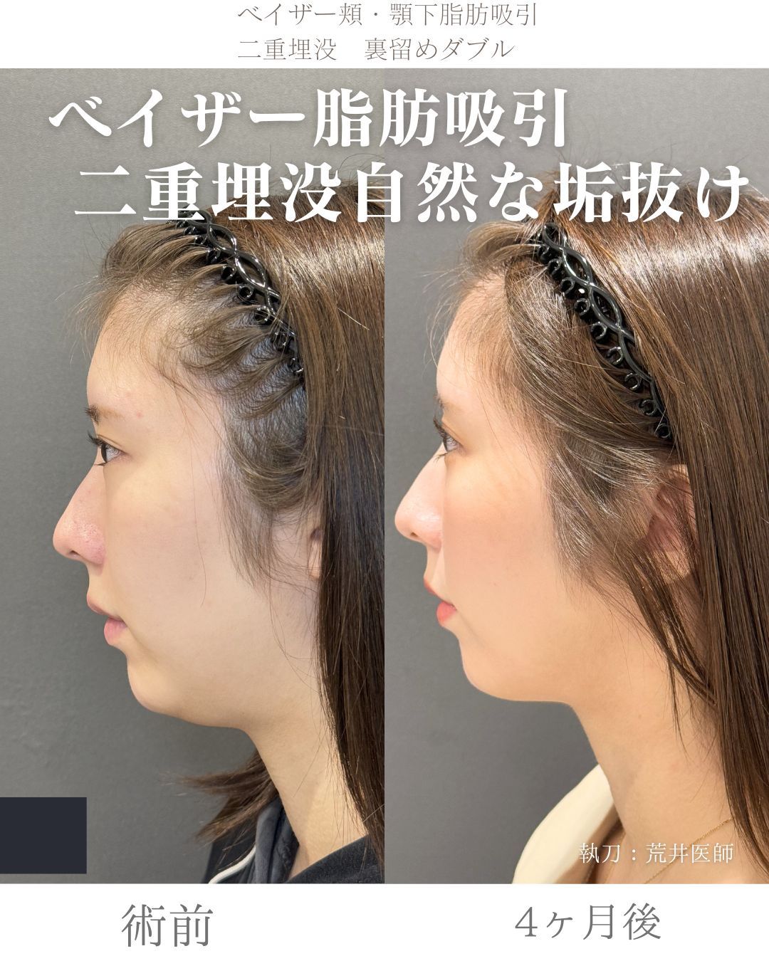 ベイザー脂肪吸引症例