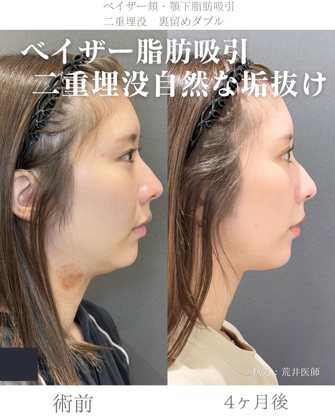 ベイザー脂肪吸引症例