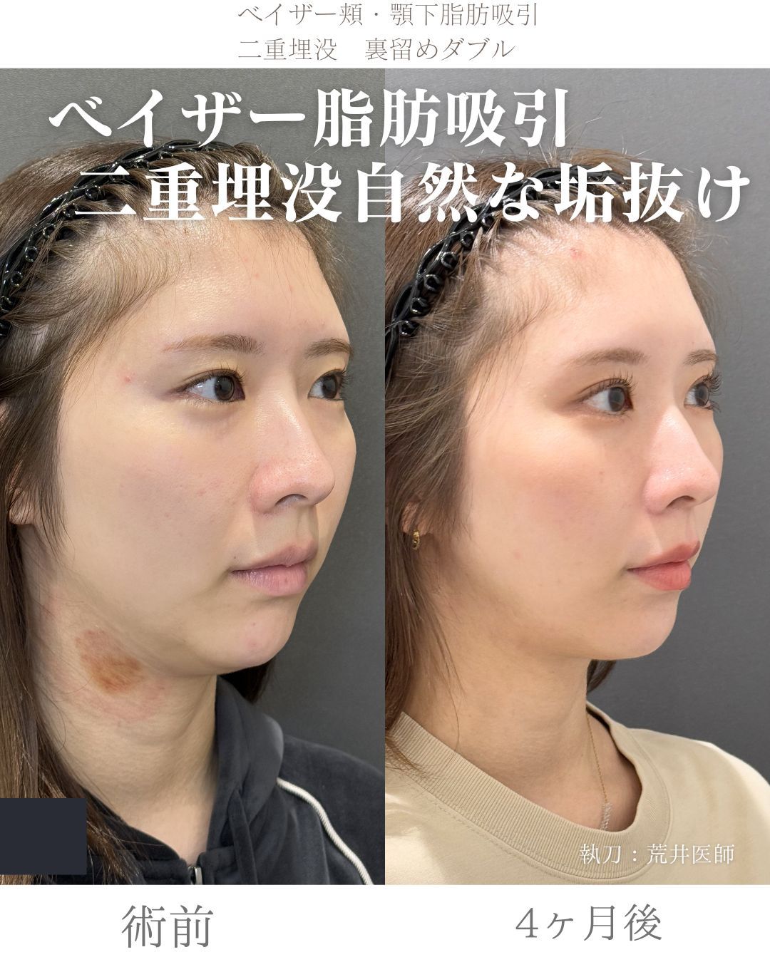 ベイザー脂肪吸引症例