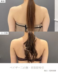 二の腕・肩脂肪吸引