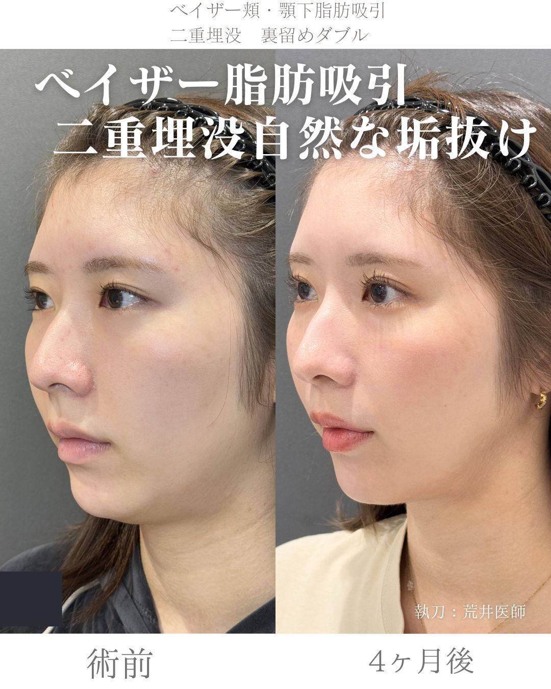 ベイザー脂肪吸引症例