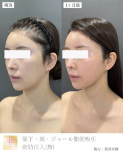 脂肪吸引