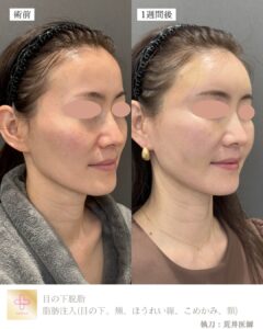 脂肪注入