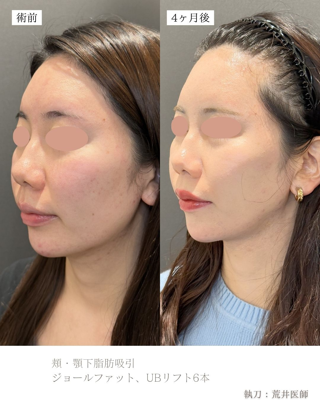 小顔脂肪吸引、ジョールファット、糸リフト