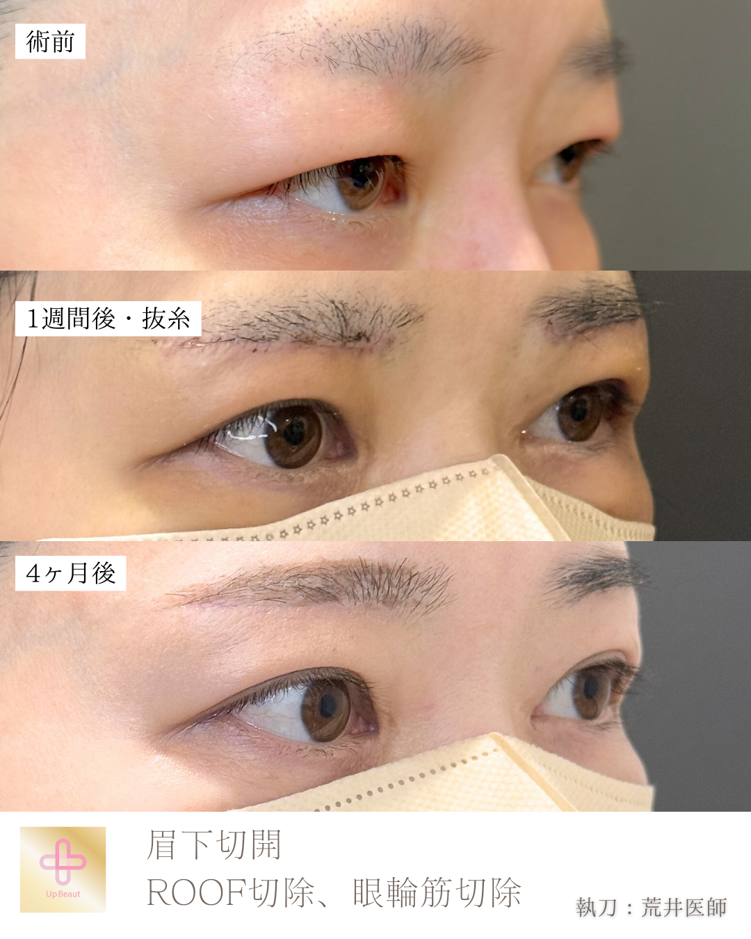 眉下切開