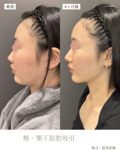 ベイザー頬・顎下脂肪吸引