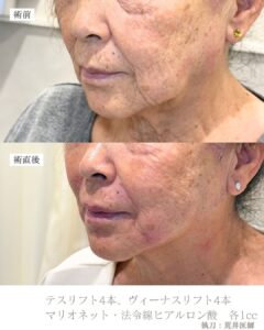 糸リフト　ヒアルロン酸