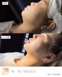 顎下脂肪吸引