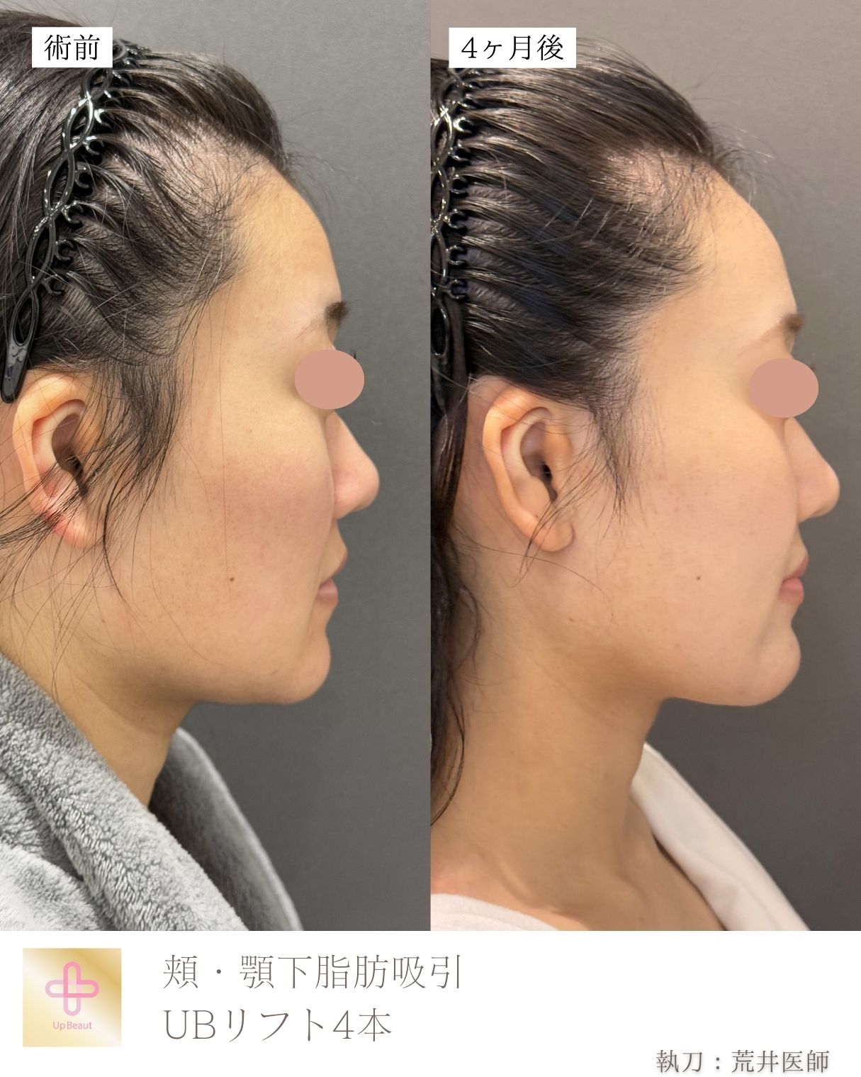 小顔脂肪吸引
