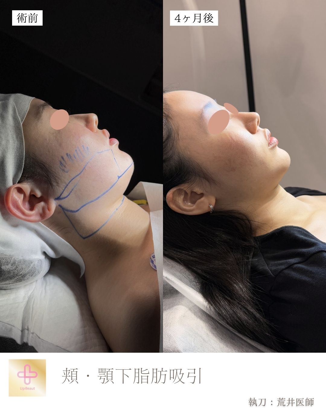 小顔脂肪吸引