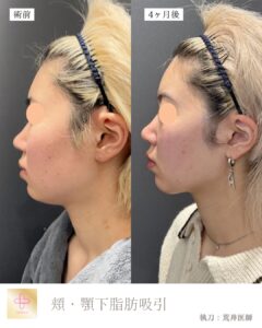 小顔脂肪吸引