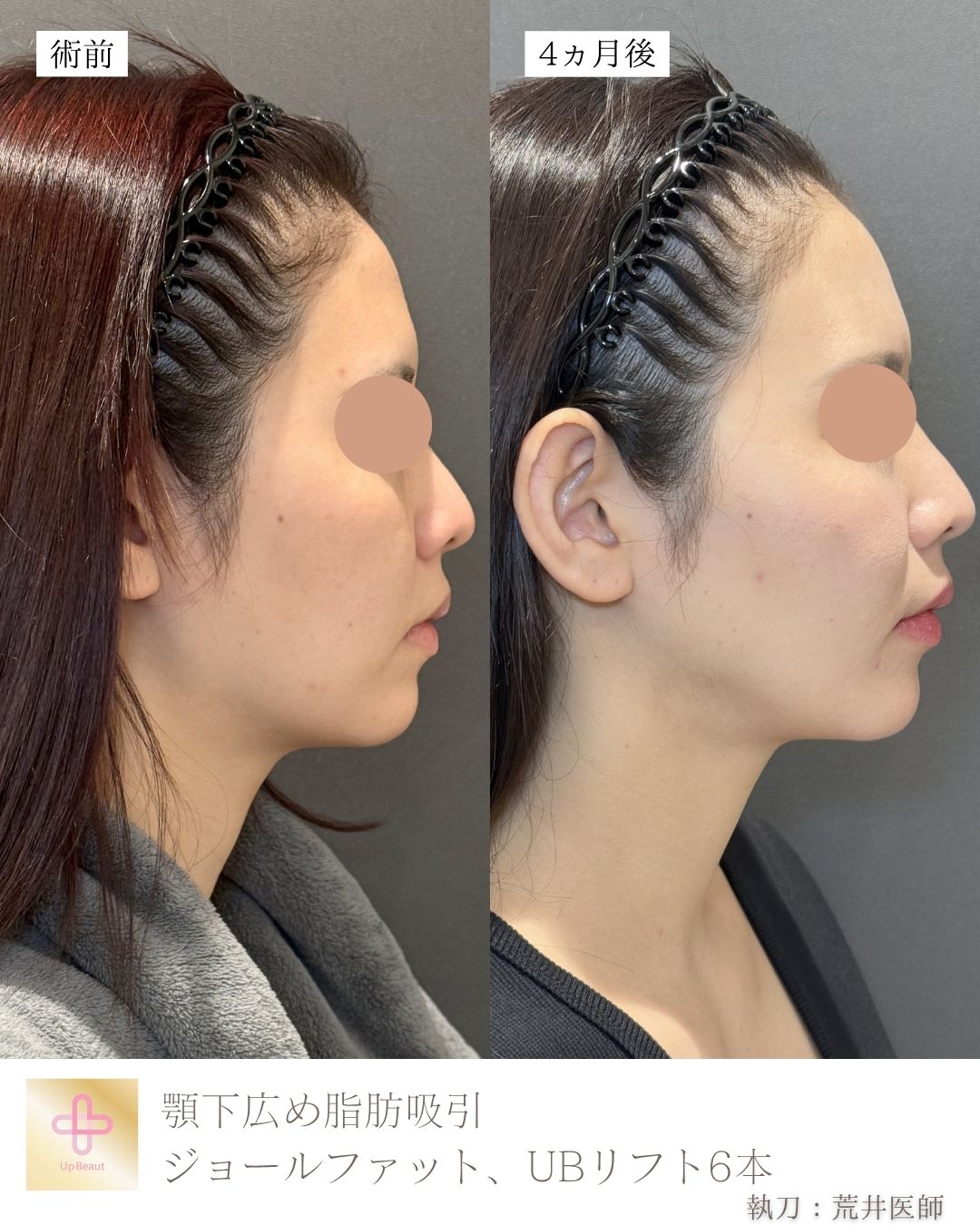 古賀お脂肪吸引