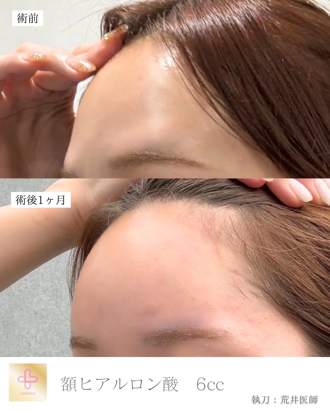 額ヒアルロン酸