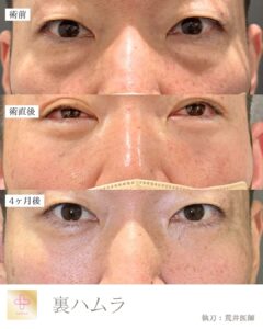 裏ハムラ