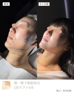 小顔脂肪吸引