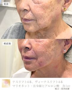 糸リフト