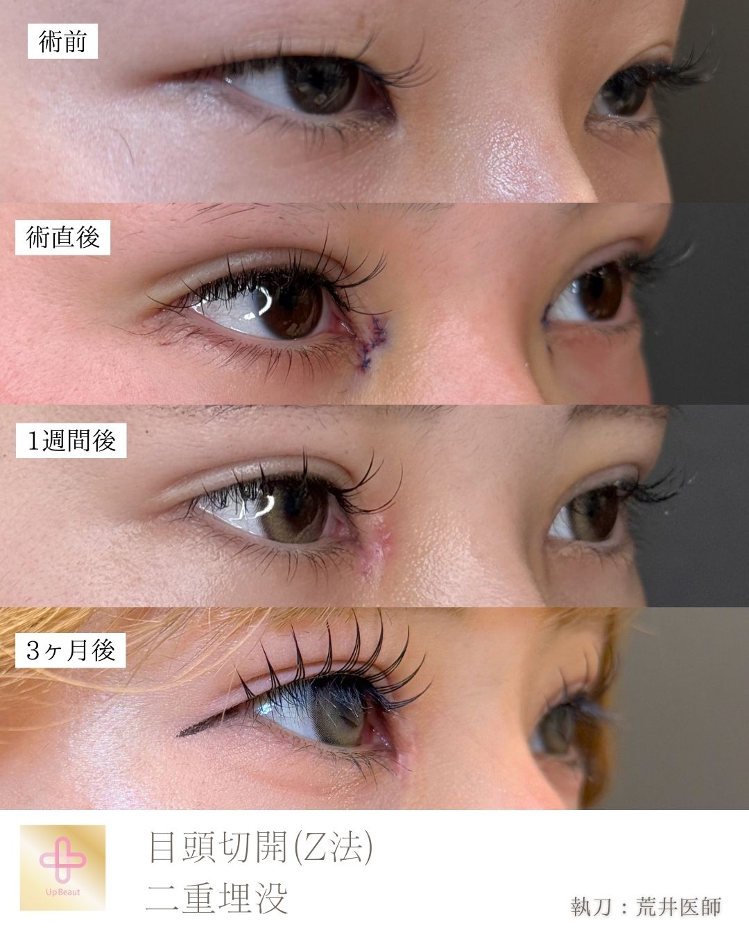 目頭切開