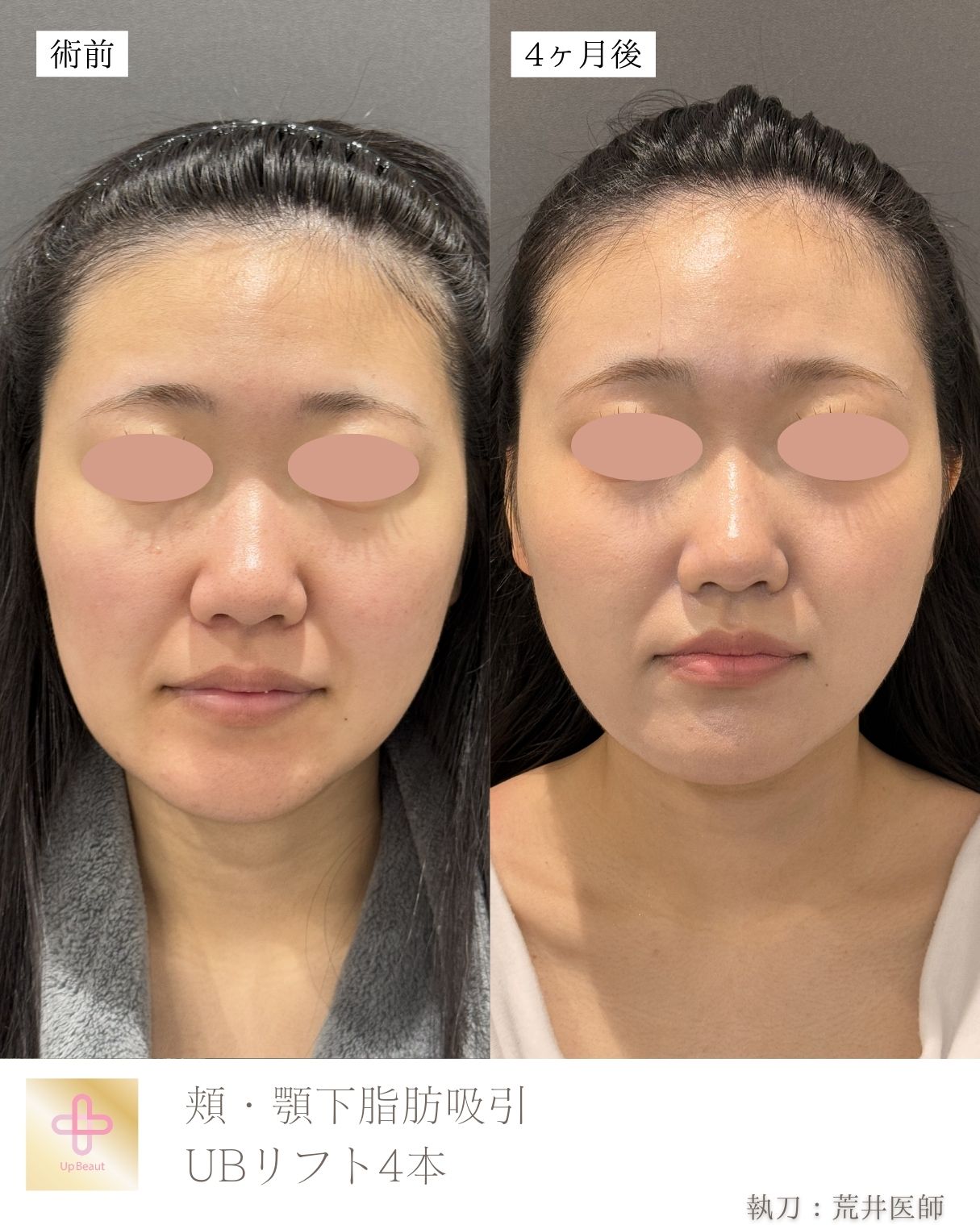 小顔脂肪吸引