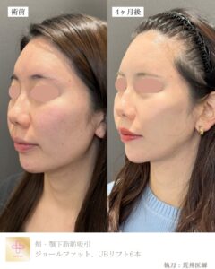 小顔脂肪吸引ダウンタイム
