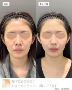 小顔脂肪吸引症例