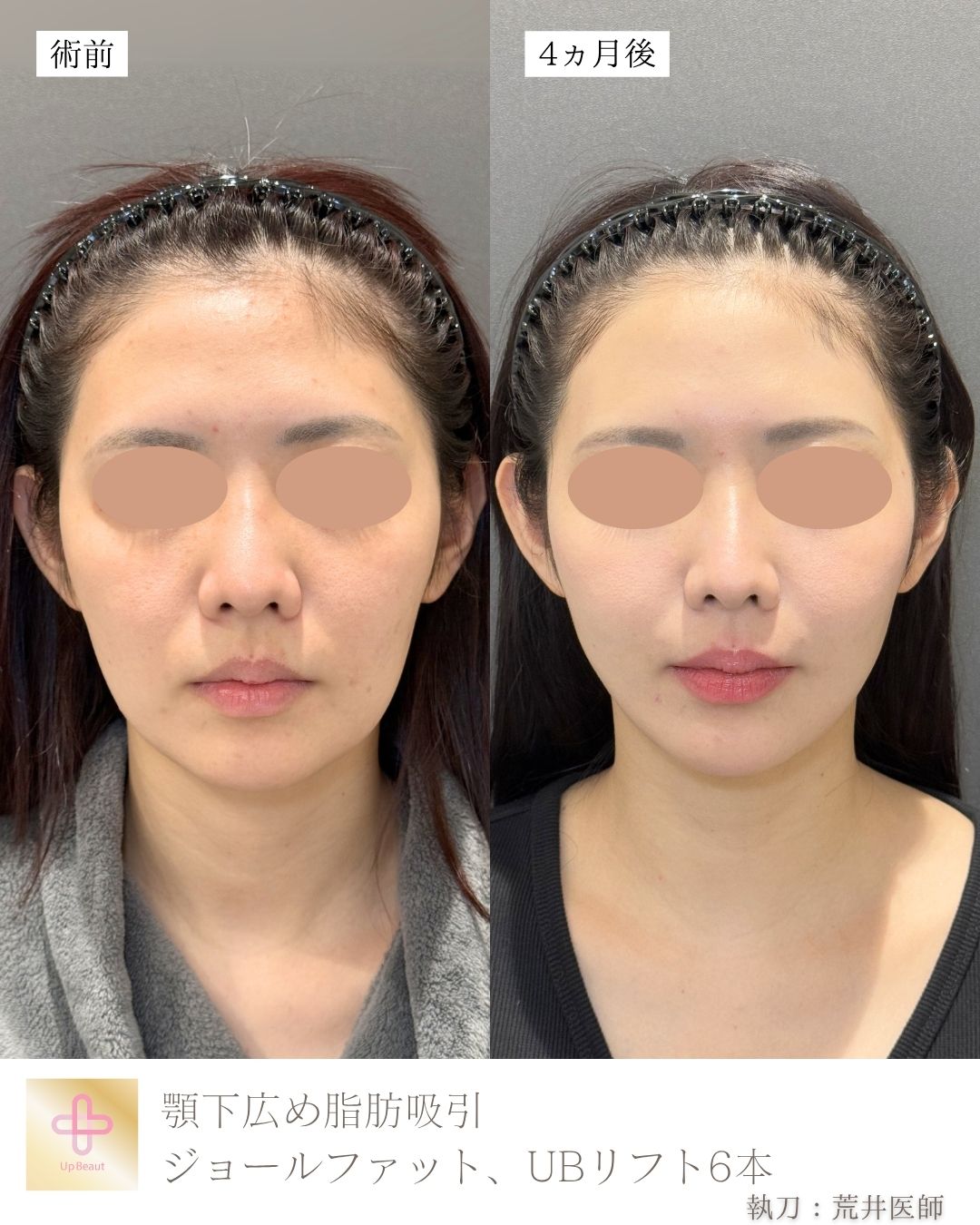 小顔脂肪吸引症例