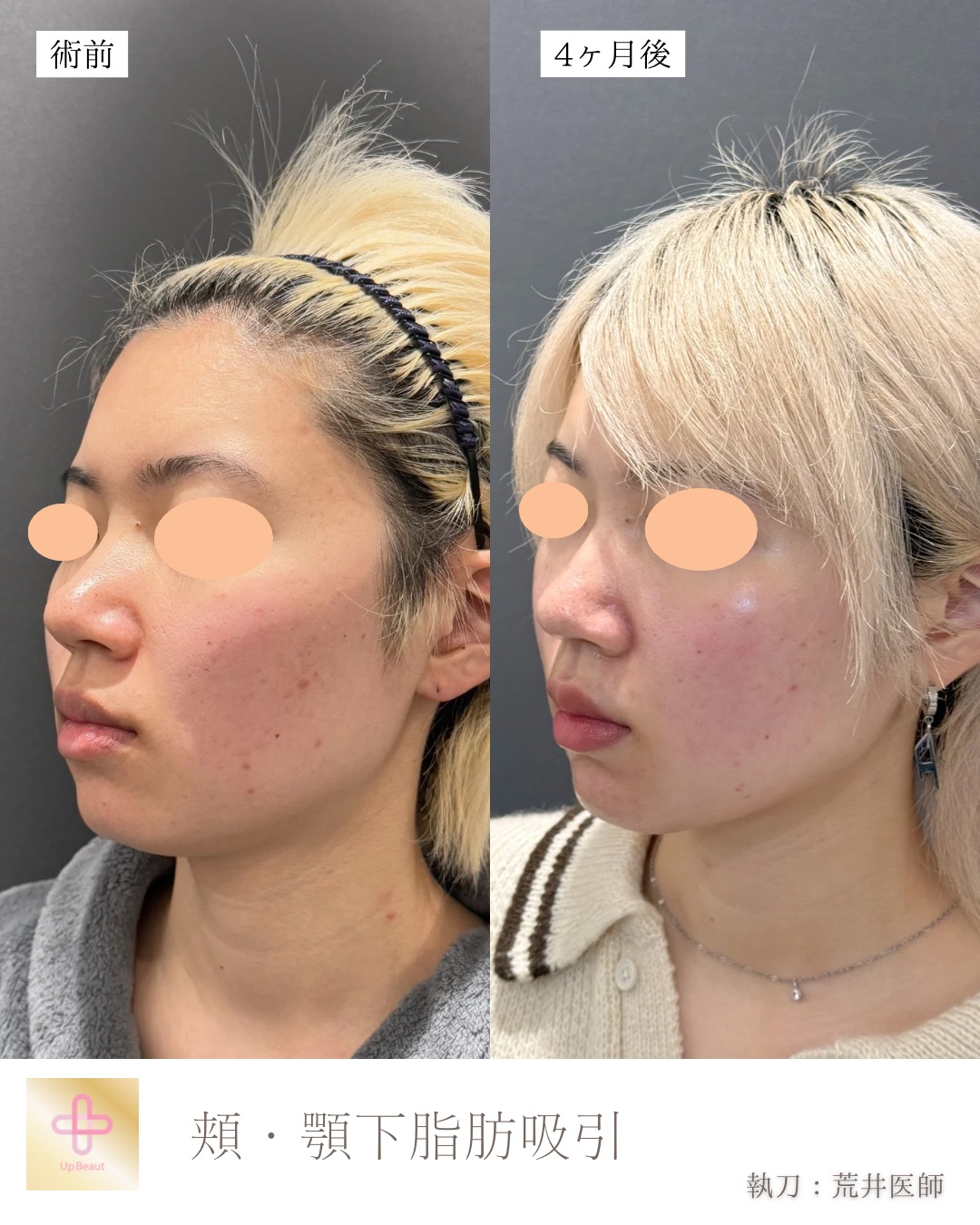 小顔脂肪吸引