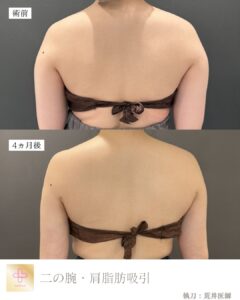二の腕脂肪吸引